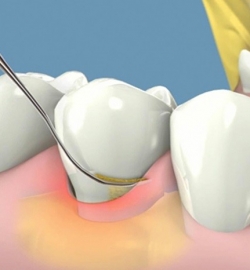 CẠO VÔI & ĐÁNH BÓNG