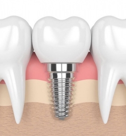RĂNG SỨ CỐ ĐỊNH