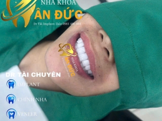  Hoàn thành 23 răng sứ cao cấp – Hành trình tin tưởng tuyệt đối vào Bs Tài