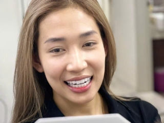 Hoàn thiện 20 răng zolid thẩm mỹ – Trao lại nụ cười tự tin cho khách hàng