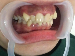 Cắt lợi làm dài thân răng và mài xương ổ cho KH Combodia – Giải pháp cho nụ cười cân đối, khỏe đẹp