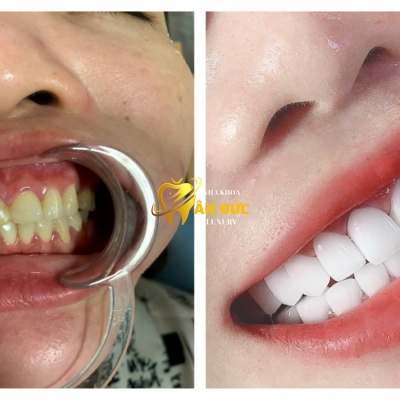 KHÁCH HÀNG TẠI NHA KHOA ÂN ĐỨC 8